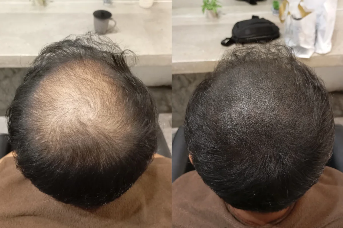 Anggun Pakar Rambut client, before and after