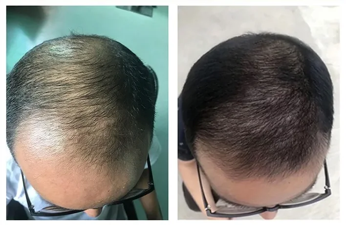 Client scalp before and after SMP at NPM Malaysia